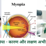 मायोपिया - कारण और लक्षण