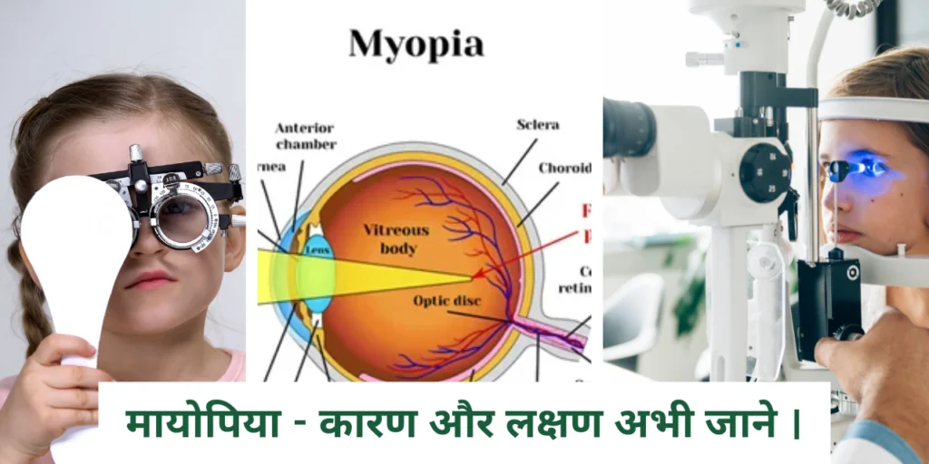 मायोपिया - कारण और लक्षण