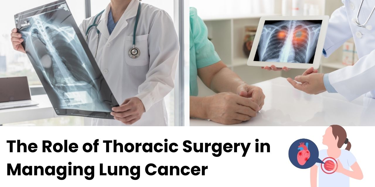 The Role of Thoracic Surgery in Managing Lung Cancer