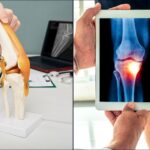 How to Recognize the Early Signs of Osteoarthritis