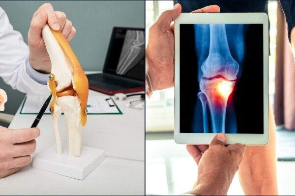 How to Recognize the Early Signs of Osteoarthritis