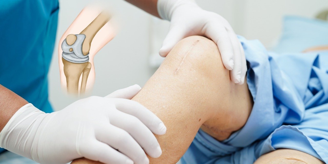 Understanding Knee Replacement Surgery: A Complete Guide for Patients